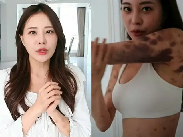 AORI, một người đẹp YouTube, tiết lộ rằng việc tiêm thuốc tăng cường sức khỏe kh