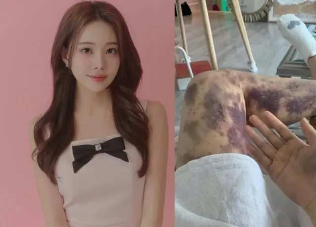 皮膚科で注射後「全身にあざ」人気ユーチューバーが勝訴＝韓国