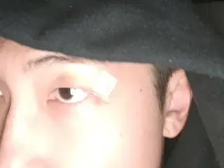 "BTS" RM, vết sẹo trên mắt anh ấy ổn chứ?
